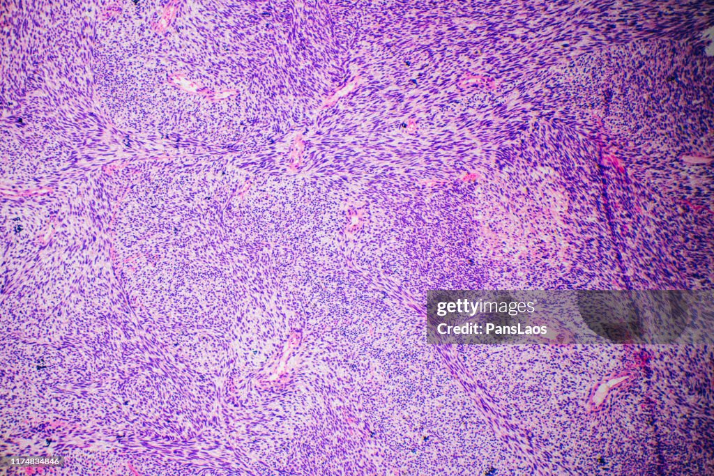 Human cancer cells fibrosarcoma