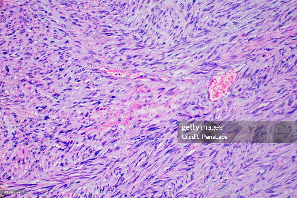 Leiomyosarcoma cancer cells of human tumor tissue