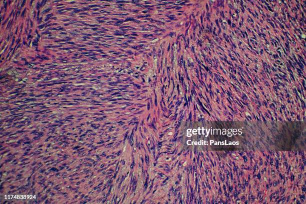 leiomyosarcoma cancer cells of human tumor tissue - smooth muscle stock pictures, royalty-free photos & images