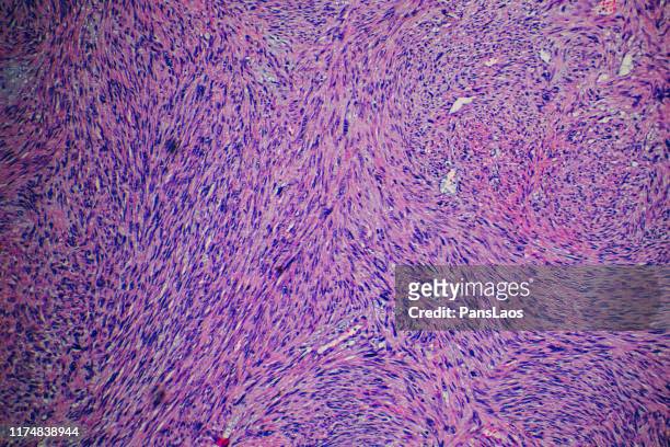 leiomyosarcoma cancer cells of human tumor tissue - muscle cell stock pictures, royalty-free photos & images
