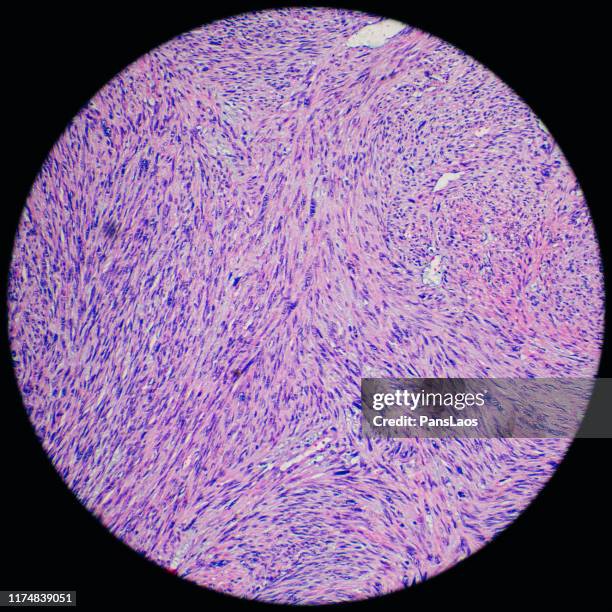 leiomyosarcoma human cancer cells under microscope - glad spierweefsel stockfoto's en -beelden