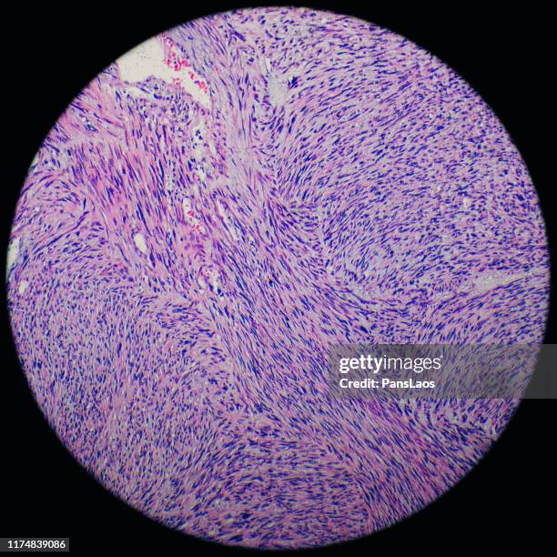 leiomyosarcoma human cancer cells under microscope - glad spierweefsel stockfoto's en -beelden