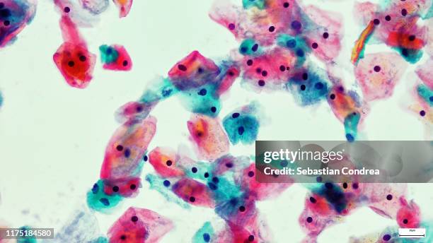 close to a cytologic smear of vagina with intermediate squamous cells, one of which contains numerous keratohyalin granules (papanicolaou stain, x 1000). - citoplasma imagens e fotografias de stock