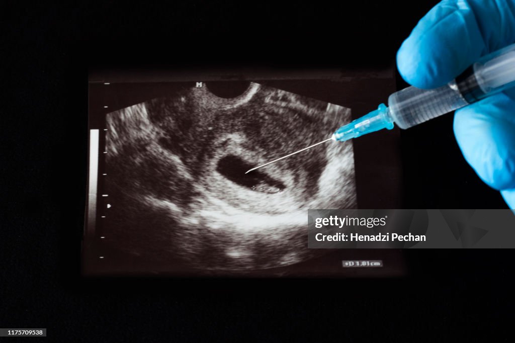 El médico inyecta una inyección en el embarazo uzi, un aborto, una jeringa, un guante, un fondo negro