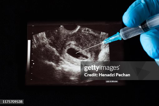 The doctor injects a shot into the uzi pregnancy, an abortion, a syringe, a glove, a black background The doctor injects a shot into the uzi pregnancy, an abortion, a syringe, a glove, a black background