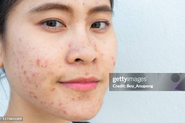 close-up of woman face with problems of acne inflammation (papule and pustule) on her face and she looking to camera. - 乾燥肌 ストックフォトと画像