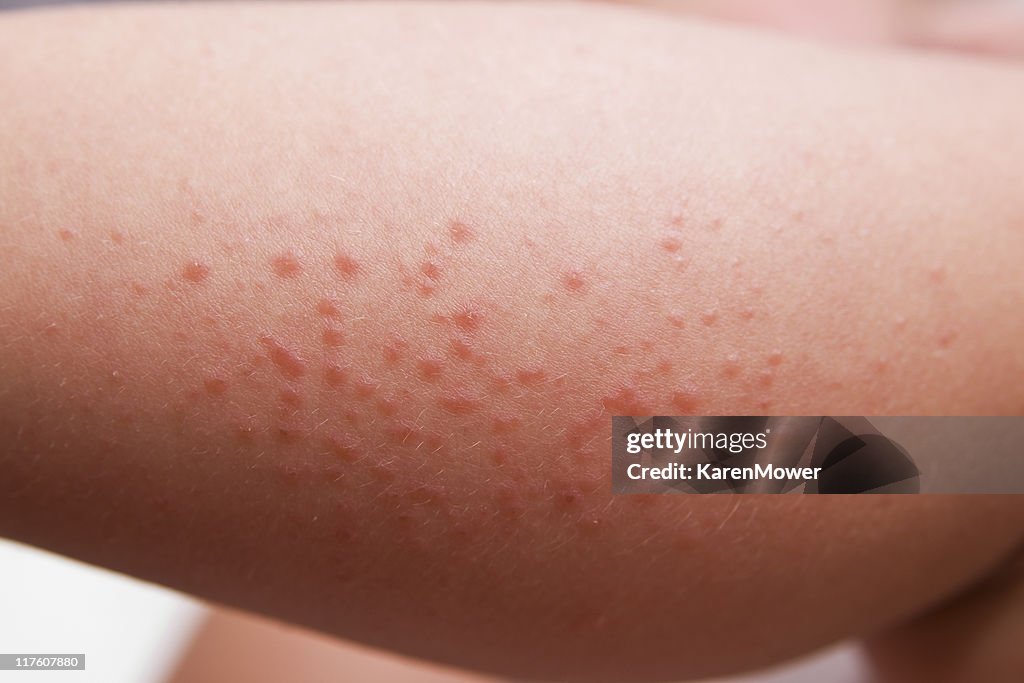 Rash Photo - Getty Images