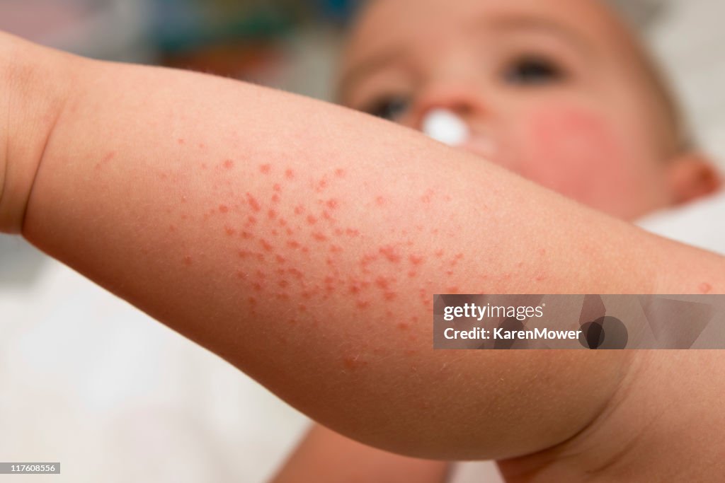 Flickr Bebe Rash Bébé Rash Photo - Getty Images