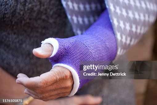 Broken arm Broken arm