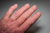 Hand of a psoriasis patient close-up. Psoriatic arthritis. Joint deformation and inflammation on the skin. Photo with dark vignetting. Soft focus.