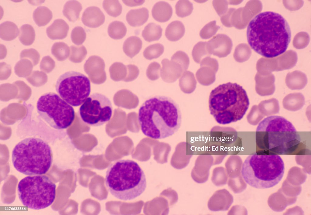 CHRONIC MYLELOGENOUS LEUKEMIA (also called MYELOGENOUS LEUKEMIA) many MYELOBLASTS (Immature white blood cells or leukocytes) 250X