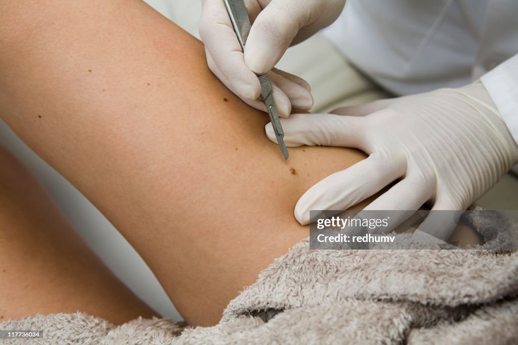 Dermatologist remove moles
