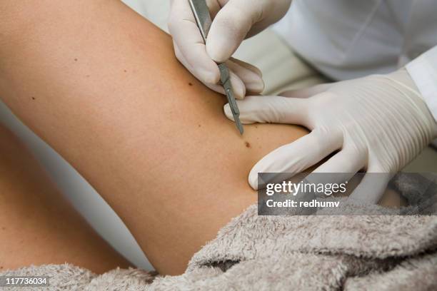 dermatologist removing moles with tools - dermatologi bildbanksfoton och bilder