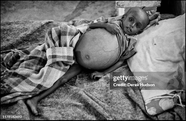 Distended 24 Distended Abdomen Stock Photos, High-Res Pictures, and Images ...