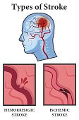 Vector illustration of Brain Stroke Types. Ischemic and Hemorrhagic types poster.
