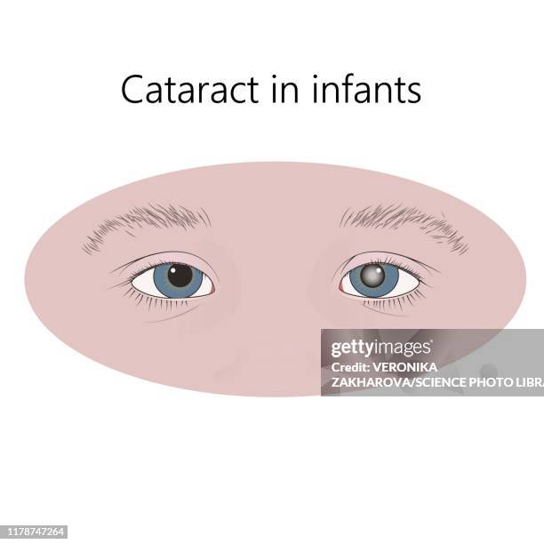 childhood cataract, illustration - lens optical instrument stock illustrations