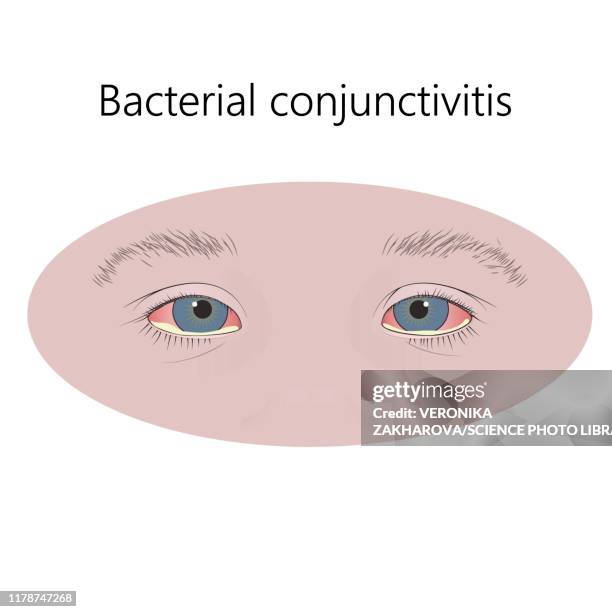 ilustraciones, imágenes clip art, dibujos animados e iconos de stock de bacterial conjunctivitis, illustration - ojos rojos