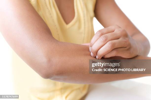 woman scratching her arm - irritation skin woman stock pictures, royalty-free photos & images