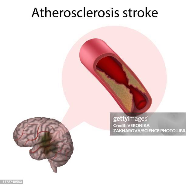 atherosclerosis stroke, illustration - cerebral blood flow stock pictures, royalty-free photos & images