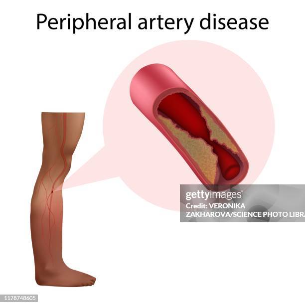 peripheral artery disease, illustration - peripheral artery disease stock pictures, royalty-free photos & images