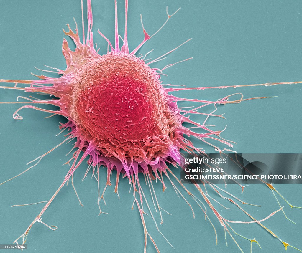 Prostate cancer cell, SEM