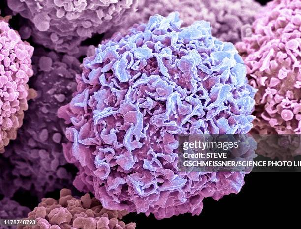 breast cancer cells, sem - micrografía electrónica escaneadora fotografías e imágenes de stock