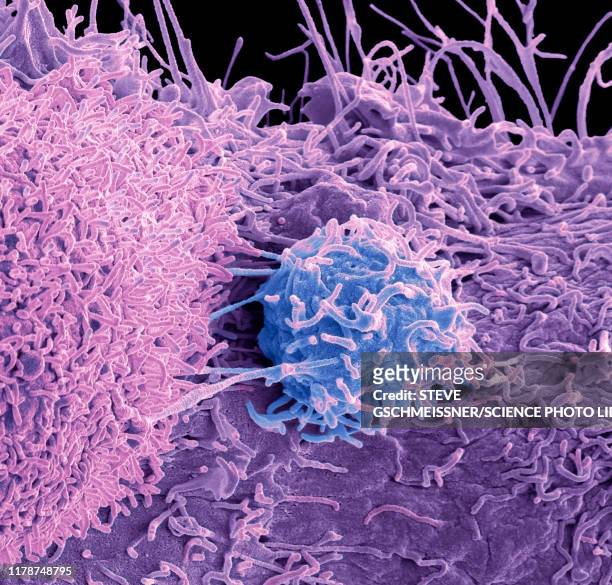 prostate cancer cells, sem - microscopio elettronico a scansione foto e immagini stock