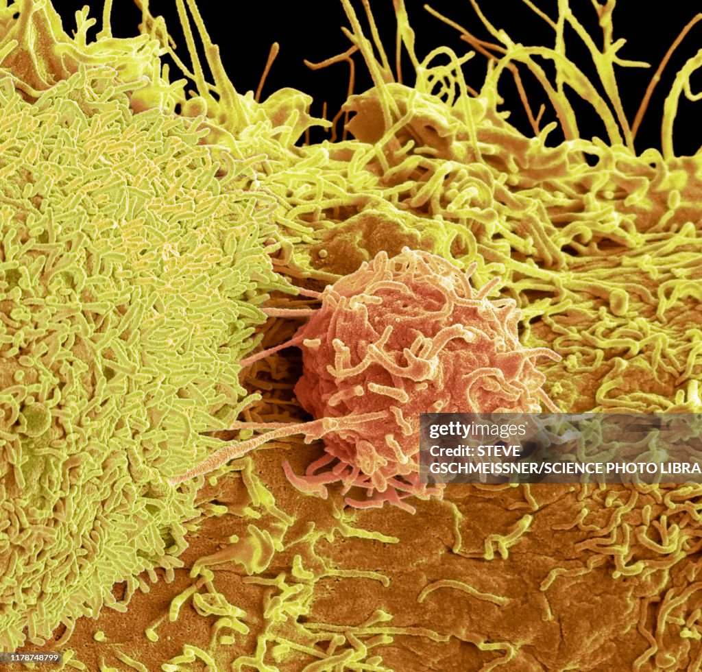 Prostate cancer cells, SEM