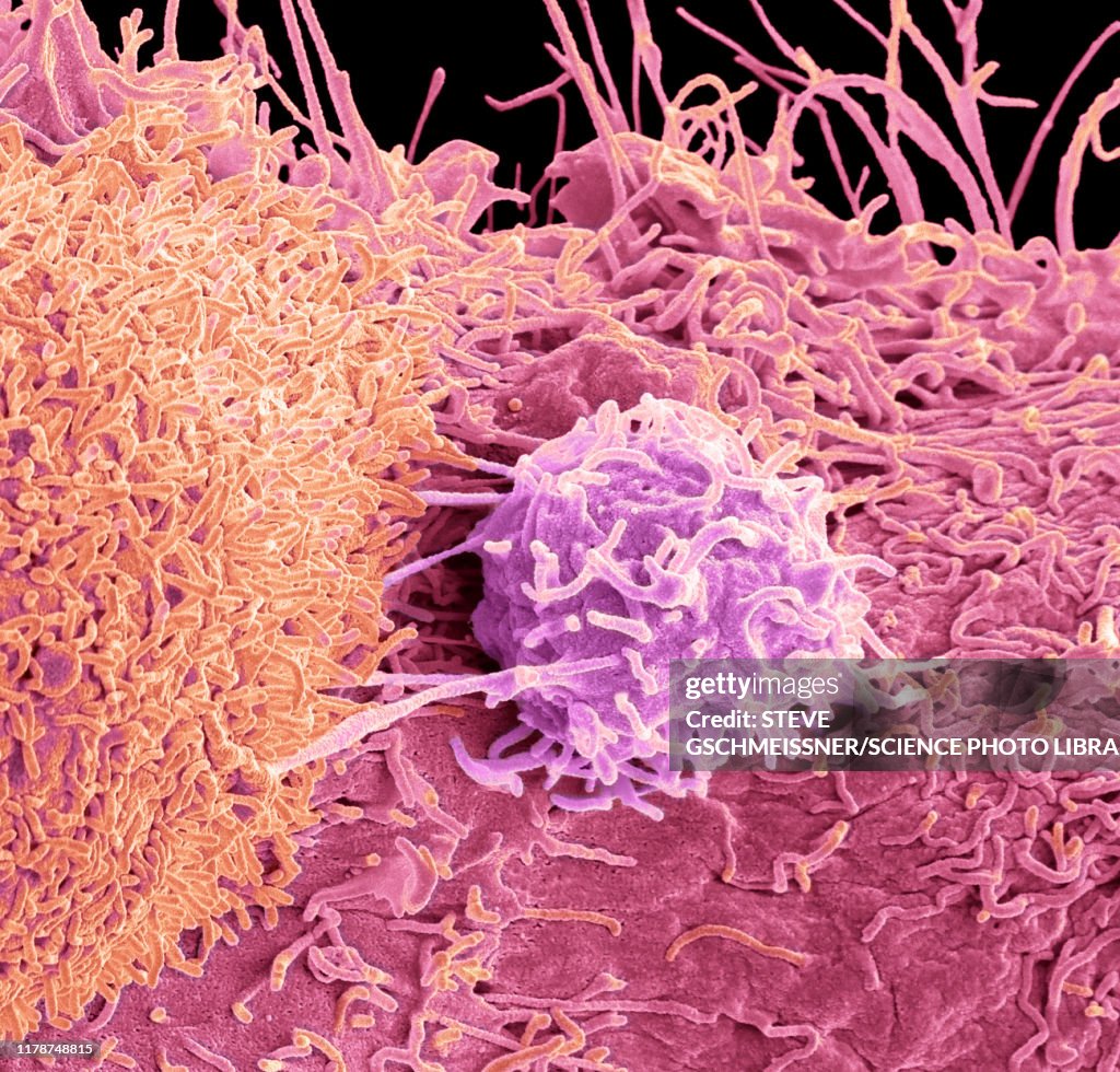 Prostate cancer cells, SEM