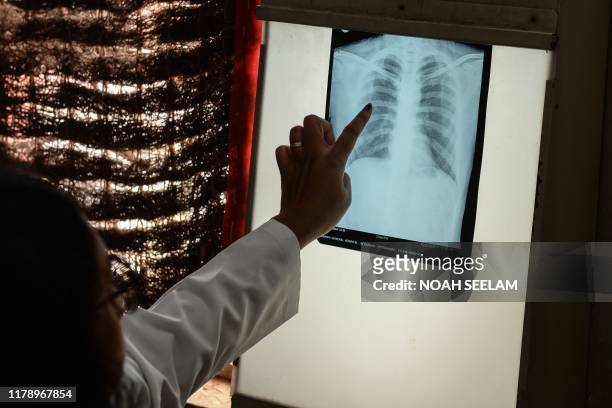 Doctor checks the chest X-ray of a patient in the tuberculosis department of the government-run Osmania General Hospital in Hyderabad on October 30,...