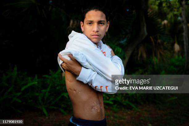 Marjory Stoneman Douglas High School shooting survivor Anthony Borges shows his injuries during an interview with AFP in Coral Springs, Florida, on...