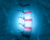 Disc problem of human spine