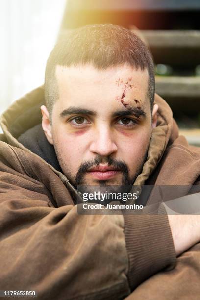 young millennial looking at the camera with a big scar in his face - cicatriz imagens e fotografias de stock