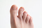 Right Caucasian male foot top view with bent crooked toe against bright white background close up