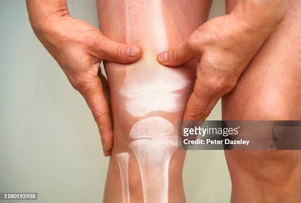 x-ray of knee - osteoarthritis and rheumatoid arthritis - knee replacement surgery foto e immagini stock