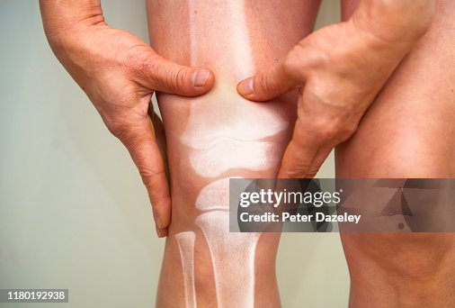 X-ray of knee - osteoarthritis and rheumatoid arthritis X-ray of knee - osteoarthritis and rheumatoid arthritis