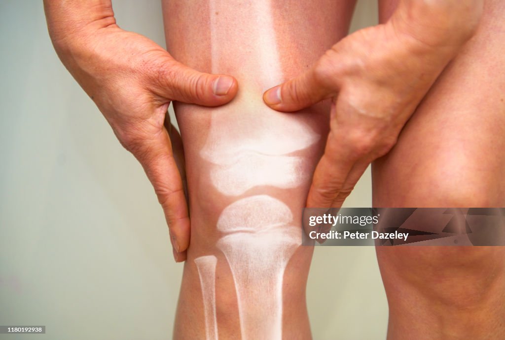 X-ray of knee - osteoarthritis and rheumatoid arthritis