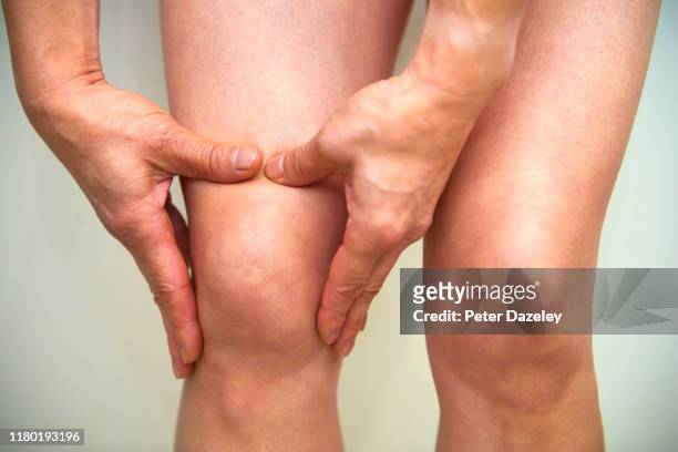 massaging knee - osteoarthritis and rheumatoid arthritis - svullen bildbanksfoton och bilder
