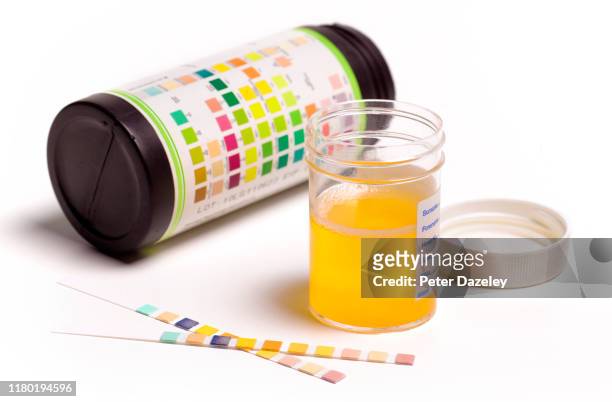 taking urine sample - kidney stone foto e immagini stock