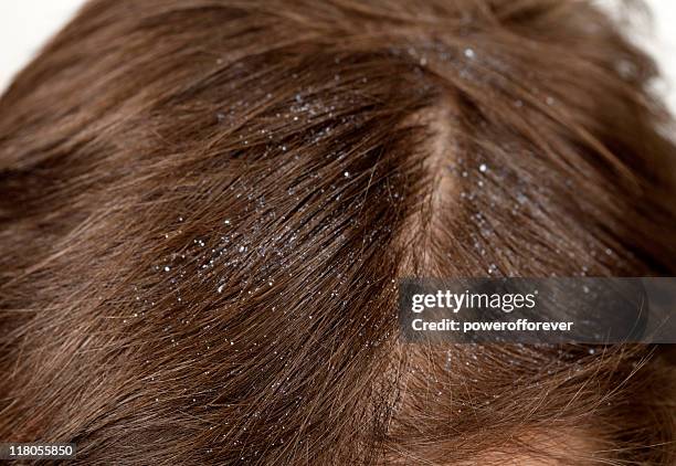 caspa - dandruff fotografías e imágenes de stock