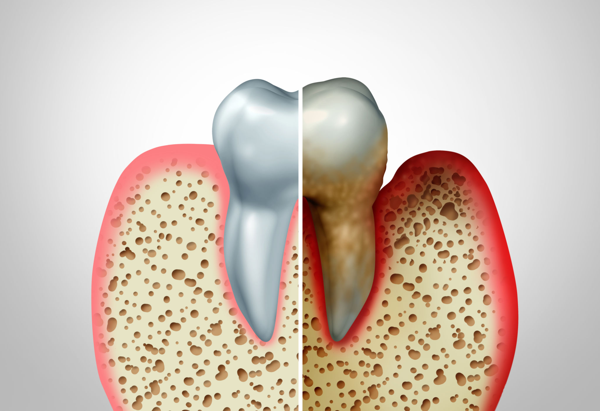 gum disease treatment