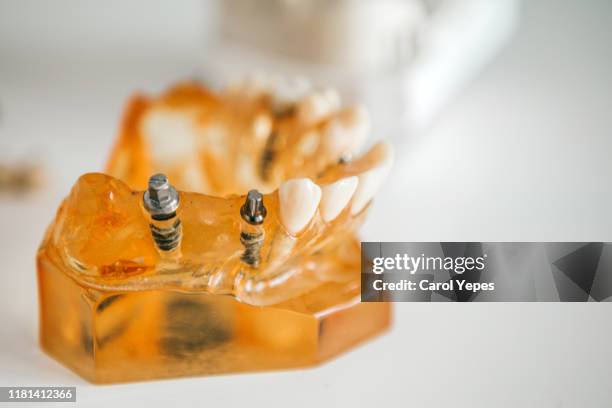 dental implant model - dental mould stock pictures, royalty-free photos & images