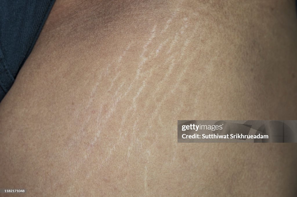 Midsection Of Man With Stretch Marks On Thigh