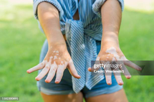 detail of the hands of a girl with skin depigmentation or vitiligo - vitiligo stock pictures, royalty-free photos & images