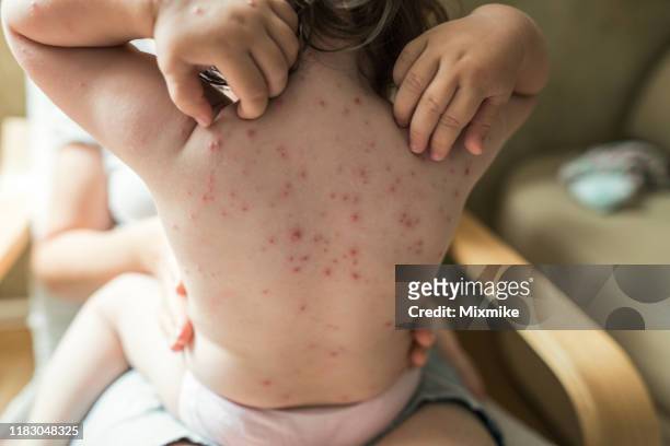 小女孩在背上抓她的水痘皮疹 - chickenpox 個照片及圖片檔