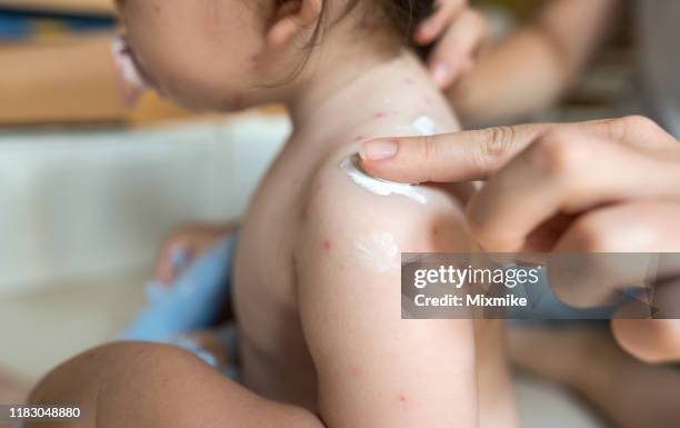 moeder aanbrengt healing cream op varicella rash - huidaandoening stockfoto's en -beelden