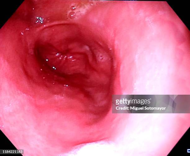 digestive endoscopy - oesophagus stock pictures, royalty-free photos & images