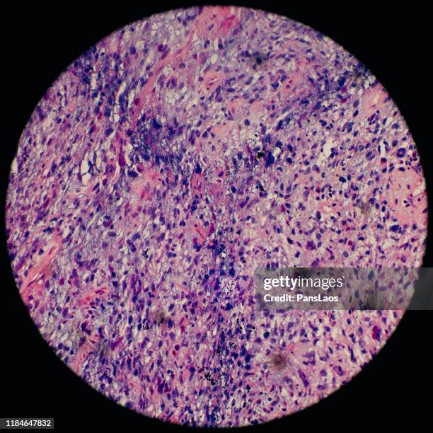 skeletal muscle tumor cells of human under microscope - cancer center imagens e fotografias de stock