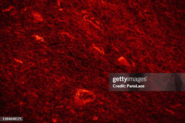 skeletal muscle tumor of human fluorescence micrograph - oncology abstract stock pictures, royalty-free photos & images