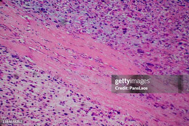 skeletal muscle tumor of human - lichtmicroscopische-foto stockfoto's en -beelden